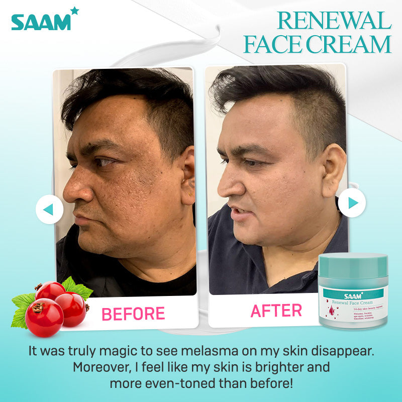 SAAM Renewal Face Cream - Specialized Treatment Cream for Melasma, Freckles, Age Spots & Dark Spots.