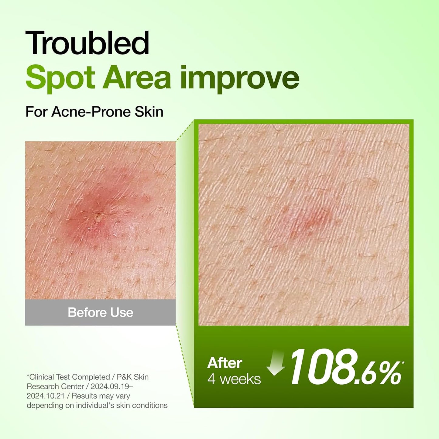 Anua Azelaic Acid 10 Hyaluron Redness Soothing Serum - Facial Serum for Blemish-Prone & Oily-Prone Skin, Lightweight & Hydrating Blemish Care, Hyaluronic Acid - 30 ml