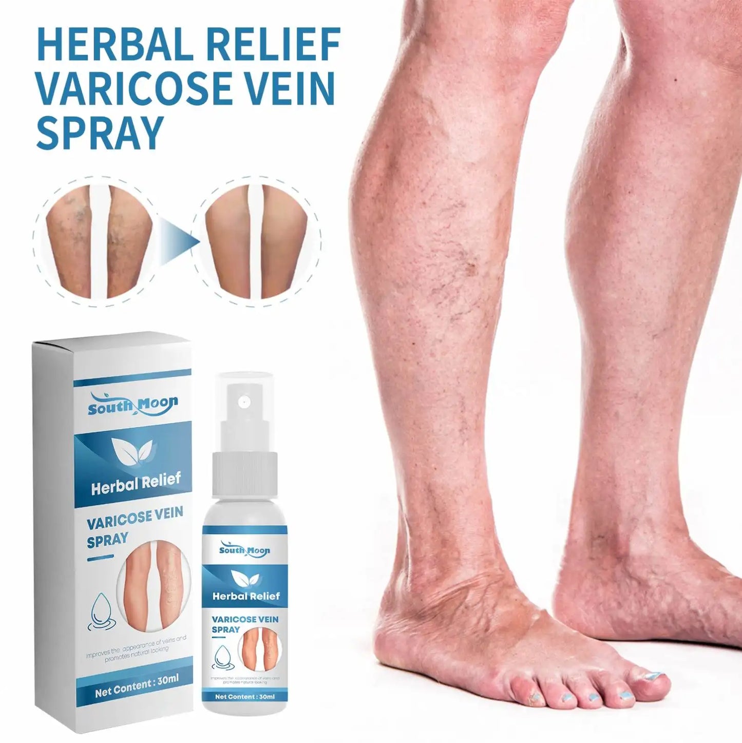 Varicose Veins Herbal Treatment Spray - Improves Blood Circulation  (BUY 1 GET 1 FREE)