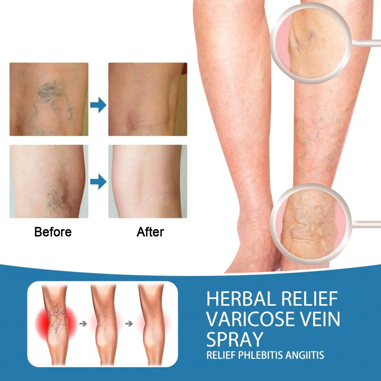 Varicose Veins Herbal Treatment Spray - Improves Blood Circulation  (BUY 1 GET 1 FREE)