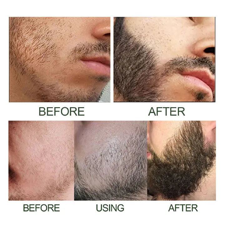 Men's Beard Growth Serum Kit With Derma Roller - Beard Growth, Nourishing & Thickening for Fuller Beard