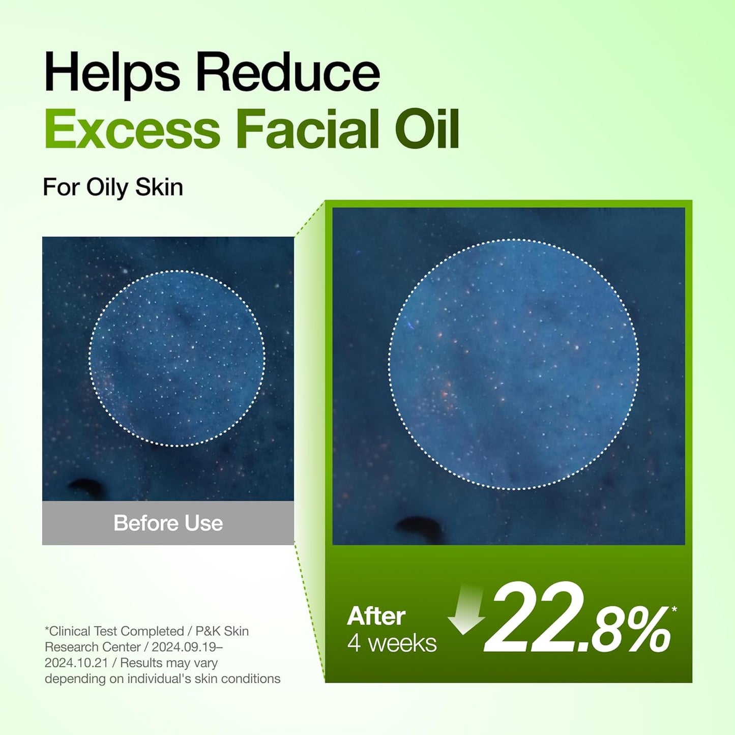 Anua Azelaic Acid 10 Hyaluron Redness Soothing Serum - Facial Serum for Blemish-Prone & Oily-Prone Skin, Lightweight & Hydrating Blemish Care, Hyaluronic Acid - 30 ml
