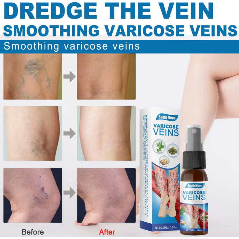 Varicose Veins Herbal Treatment Spray - Improves Blood Circulation  (BUY 1 GET 1 FREE)