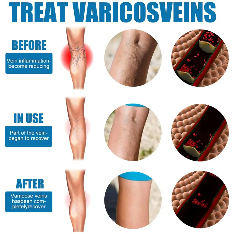 Varicose Veins Herbal Treatment Spray - Improves Blood Circulation  (BUY 1 GET 1 FREE)