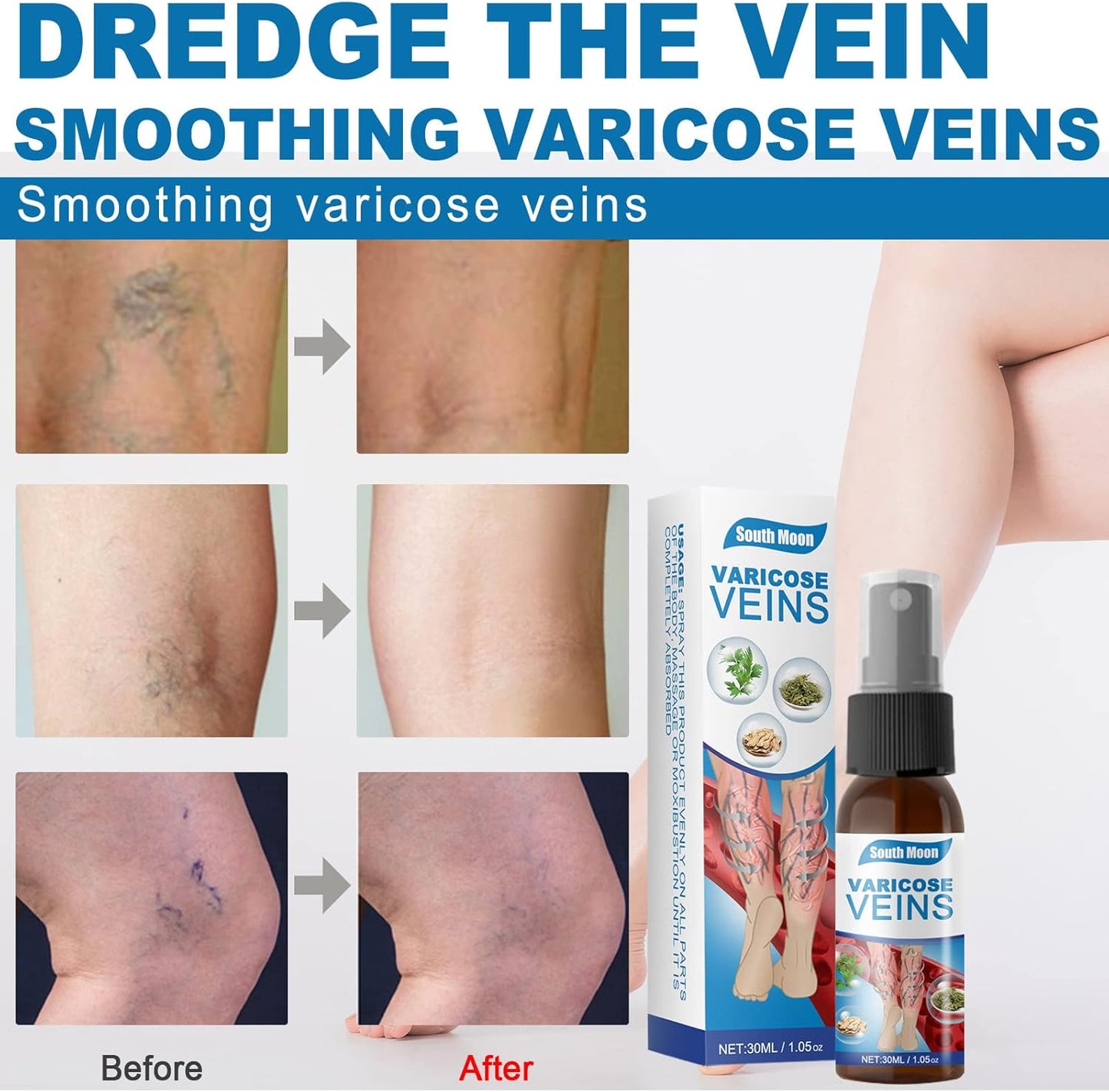 Varicose Veins Herbal Treatment Spray - Improves Blood Circulation  (BUY 1 GET 1 FREE)